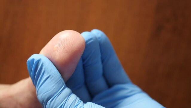 Before medical procedures, the wart on the finger is treated with alcohol. Treatment of skin diseases.