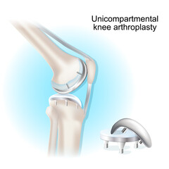 Unicompartmental knee arthroplasty. surgical procedure