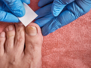 Before treatment procedures, the cavity of the nail affected by the fungus is cleaned. Treatment of...