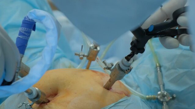 Laparoscopic cholecystectomy instrument. The surgeon's doing laparoscopic gastric sleeve surgery in the operating room