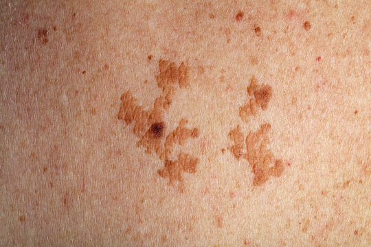 Hautver&auml;nderung