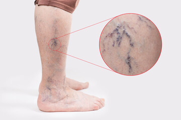 Varicosity. Close up side view of old feet of woman with vascular asterisks. Zoomed area with blood...