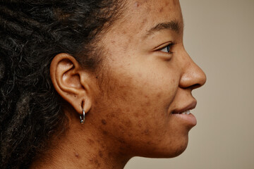 Profile ethnic young woman smiling with acne scars on face and ear piercings