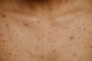 Macro shot of tan skin with acne scar spots and texture