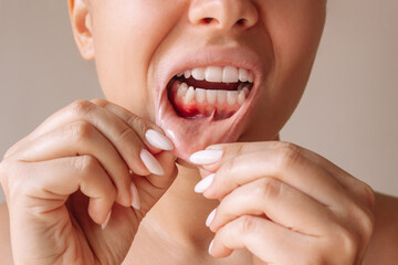 Ulcerative stomatitis on the gums. Gum inflammation. Cropped shot of a young woman showing red...