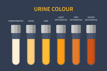 Urine colour chart. Hydration and dehydration level diagram. Medical urinal test kit for urinary tract infection research. Containers with yellow to brown pee for urinalysis. Vector illustration. - obrazy, fototapety, plakaty