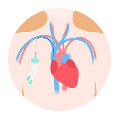 Tunneled central venous catheter placed in the subclavian vein. Patient with CVC long term access device for chemotherapy infusions and blood sampling. Central line tube close up. Vector illustration.