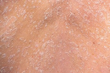 Fototapeta premium Sunburn, close-up of human skin. Flaky skin from allergies, peeling or eczema. Dry skin in need of treatment and hydration.