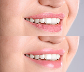 Naklejka premium Collage with photos of woman before and after using lip balm on grey background, closeup