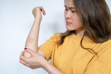 Worried woman having bruise occur on her skin. A bruise is a common skin injury that results in a...