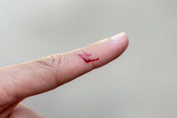 A finger that was injured by a knife and was bleeding.