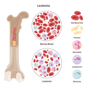 Normal blood and blood affected by leukemia disease. Dangerous