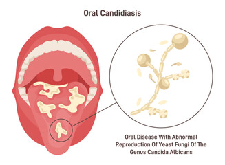 Oral candidiasis. Oral yeast infection of fungal candida albicans