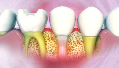 Tooth implant, Healthy teeth and dental implant, 3d illustration