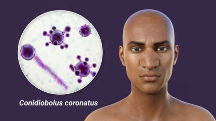 Rhinofacial conidiobolomycosis in a man and Conidiobolus coronatus fungi, 3D illustration. Tropical fungus, causes polyps or under skin masses in nasal cavity
