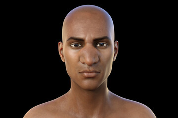 Rhinofacial conidiobolomycosis in a man, 3D illustration. A chronic mycosis causes by Conidiobolus coronatus microscopic fungus