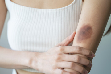 woman get injured and have bruised on her arm. - obrazy, fototapety, plakaty