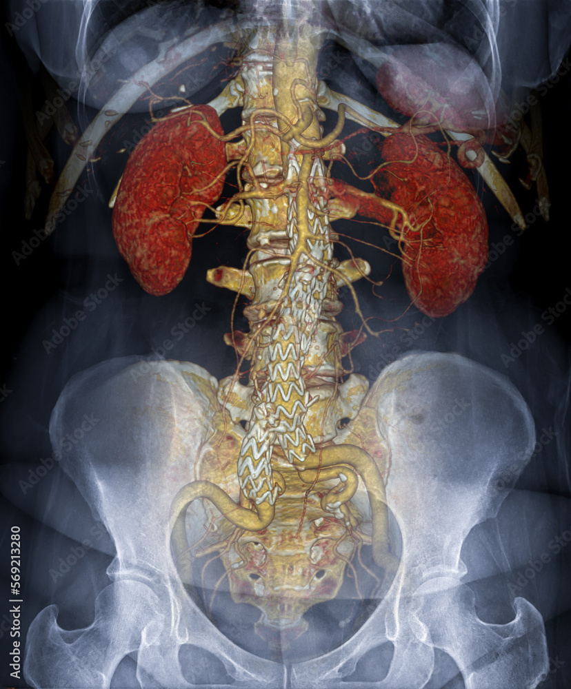 Poster cta abdominal aorta 3d rendering fusion with x-ray abdomen image.