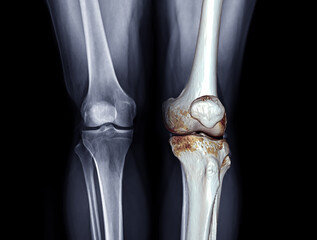 X-ray image of  both knee AP view for diagnostic Osteoarthritis or knee fracrure.