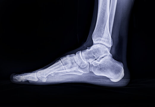 Foot x-ray image Lateral view  isolated on black background.