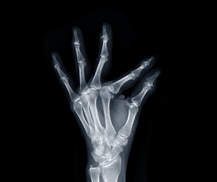 Film x-ray both hand AP view show  human's hands isolated  on black background .