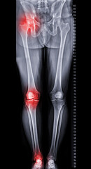 Scanogram is a Full-length standing AP radiograph of both lower extremities including the hip,...