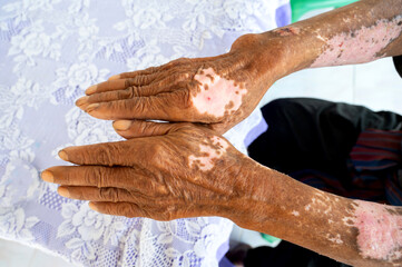 White spotted skin disease on hand and arm asian man.The skin fungus is very itchy.Psoriasis is a chronic disease.