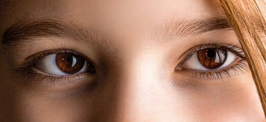 Strabismus. Close-up part child's face, eyes girl. Little patient strabismus, treatment ophthalmic...