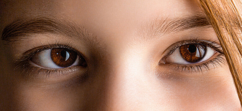 Strabismus. Close-up part child's face, eyes girl. Little patient strabismus, treatment ophthalmic diseases. Strabismus in children causes, treatment concept. Female eyes with strabismus. Hypertropia