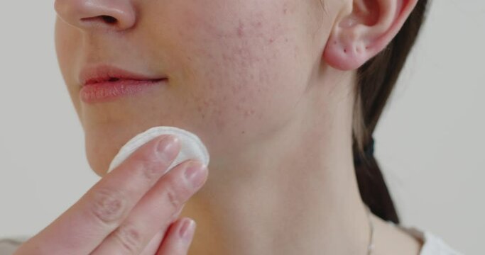 Cropped view of the teen girl with problem skin applying treatment cream