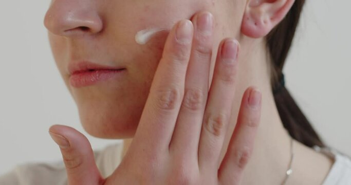 Cropped View Of The Teen Girl With Problem Skin Applying Treatment Cream