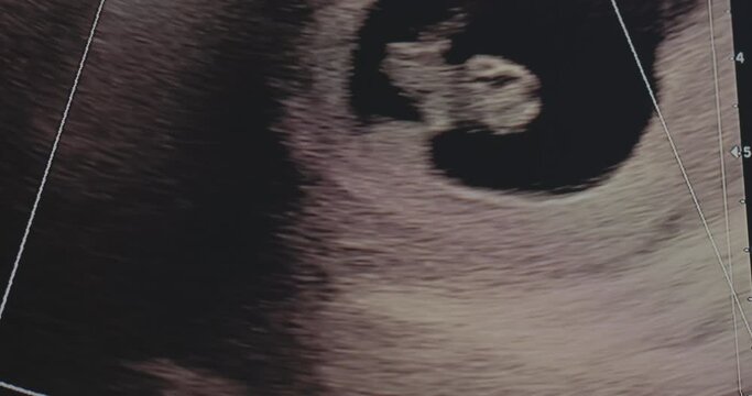 Ultrasound of an 8-week-old fetus in a mother's womb, showing colorized blood flow of the fetus. 4K footage.