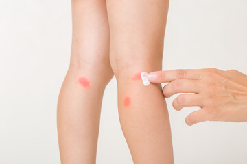 Young adult mother finger applying white moisturizing cream on toddler leg on light gray background. Red rash after bite of mosquito or food allergy. Care about child body skin. Closeup. Side view.