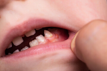 Red swelling on the gums of a child in the oral cavity. Fistula-bump due to bacteria of the diseased tooth. Deep caries. Close-up