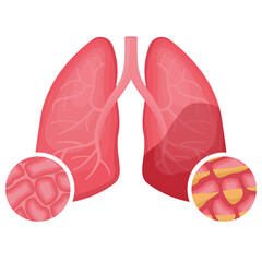 Pneumonia causes an accumulation of fluid in the alveoli. Flat vector illustration of human lungs. Organs damaged by viral disease, coronavirus