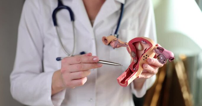 Gynecologist shows anatomical model of uterus and ovaries with pathologies