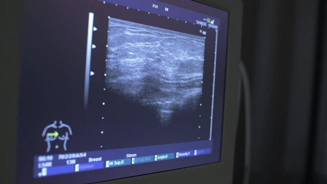 a close-up image on the monitor of the result of an ultrasound examination of the breast.