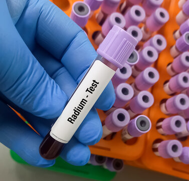 Blood sample for Radium (heavy metal) test, toxic metal. Diagnosis of radium toxicity