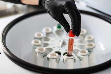 The doctor takes out a test tube with blood plasma from the centrifuge. Plasma lifting procedure for skin rejuvenation.