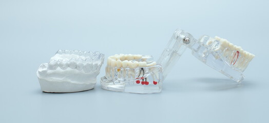 Dental jaw model over blue background. Dentist dental prosthetic teeth, gums, roots close-up.