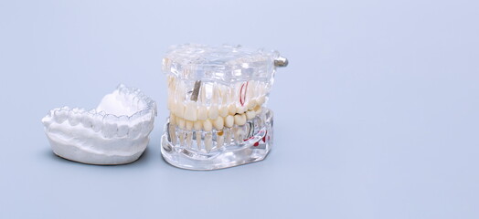 Dental jaw model over blue background. Dentist dental prosthetic teeth, gums, roots close-up.