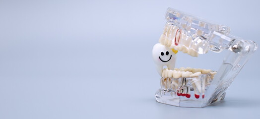 Dental jaw model over blue background. Dentist dental prosthetic teeth, gums, roots close-up.