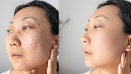 Asian woman's face before and after acne treatment procedure. Skin care concept.