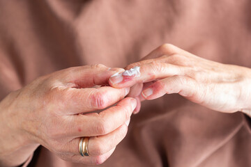 Applying ointment to hands with atopic dermatitis, eczema, allergy