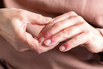 Woman hands with atopic dermatitis, eczema, allergy reaction on skin