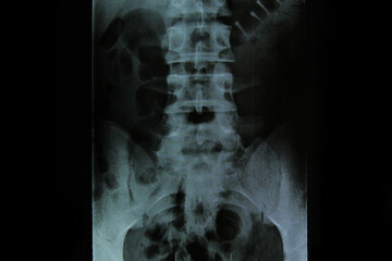 x-ray x-ray spine medicine man