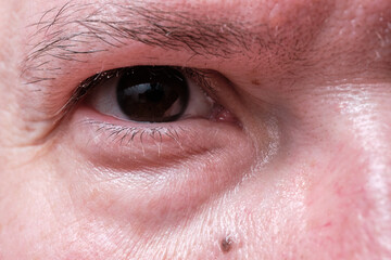 Close-up of a man's eye, swelling and wrinkles, skin redness.