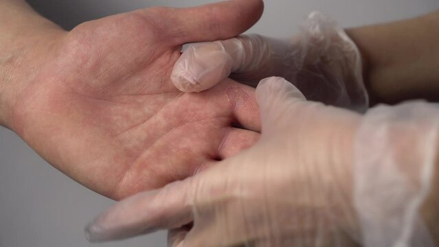 A doctor examines a fungal disease on a man's hand. Callus on the finger. Close-up hands.