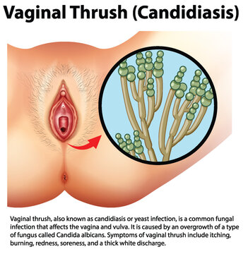 Candida varginal online