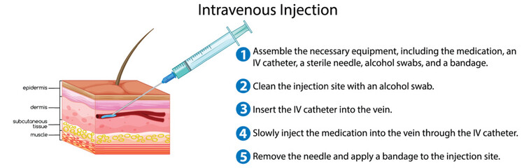 Intravenous Injection with explanation
